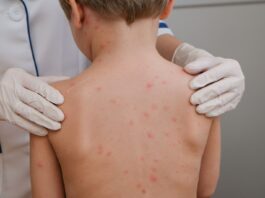 Confirman dos nuevos casos de sarampión en Cabo San Lucas; ya suman cuatro